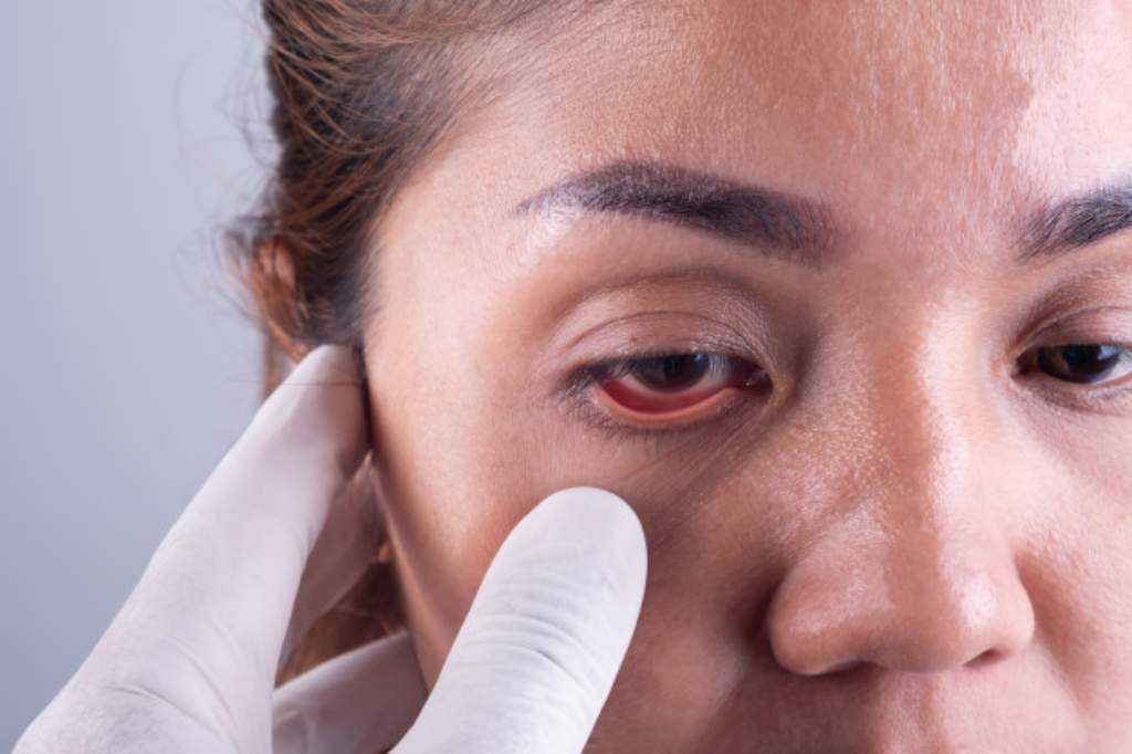 glaukoma - penyebab sakit mata sebelah