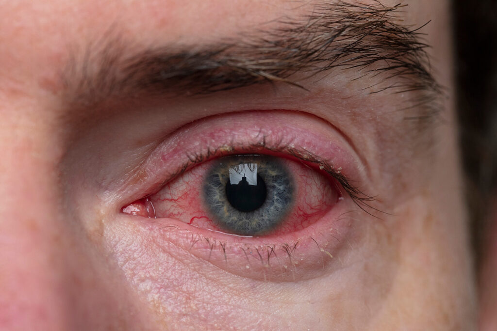 penyebab mata merah sebelah - konjungtivitis