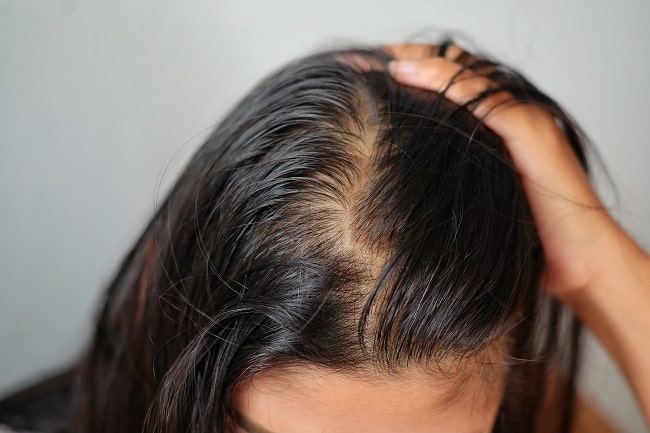 alopecia