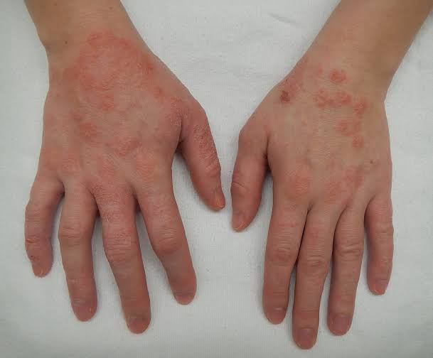 Penyakit kulit dermatitis atopik