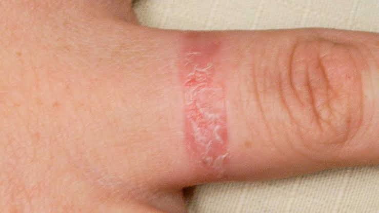 Penyakit kulit dermatitis